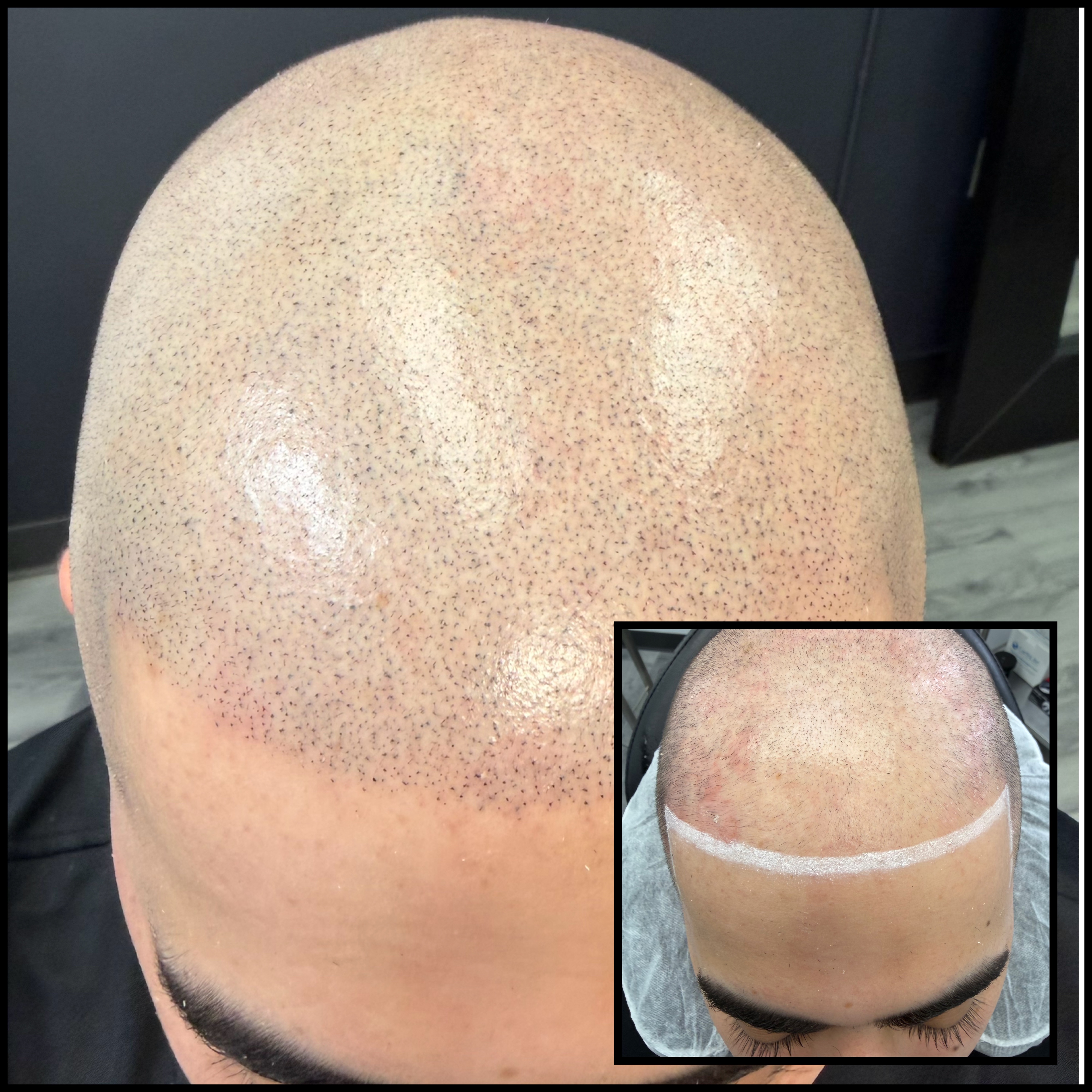 Skalp Ink Micropigmentation