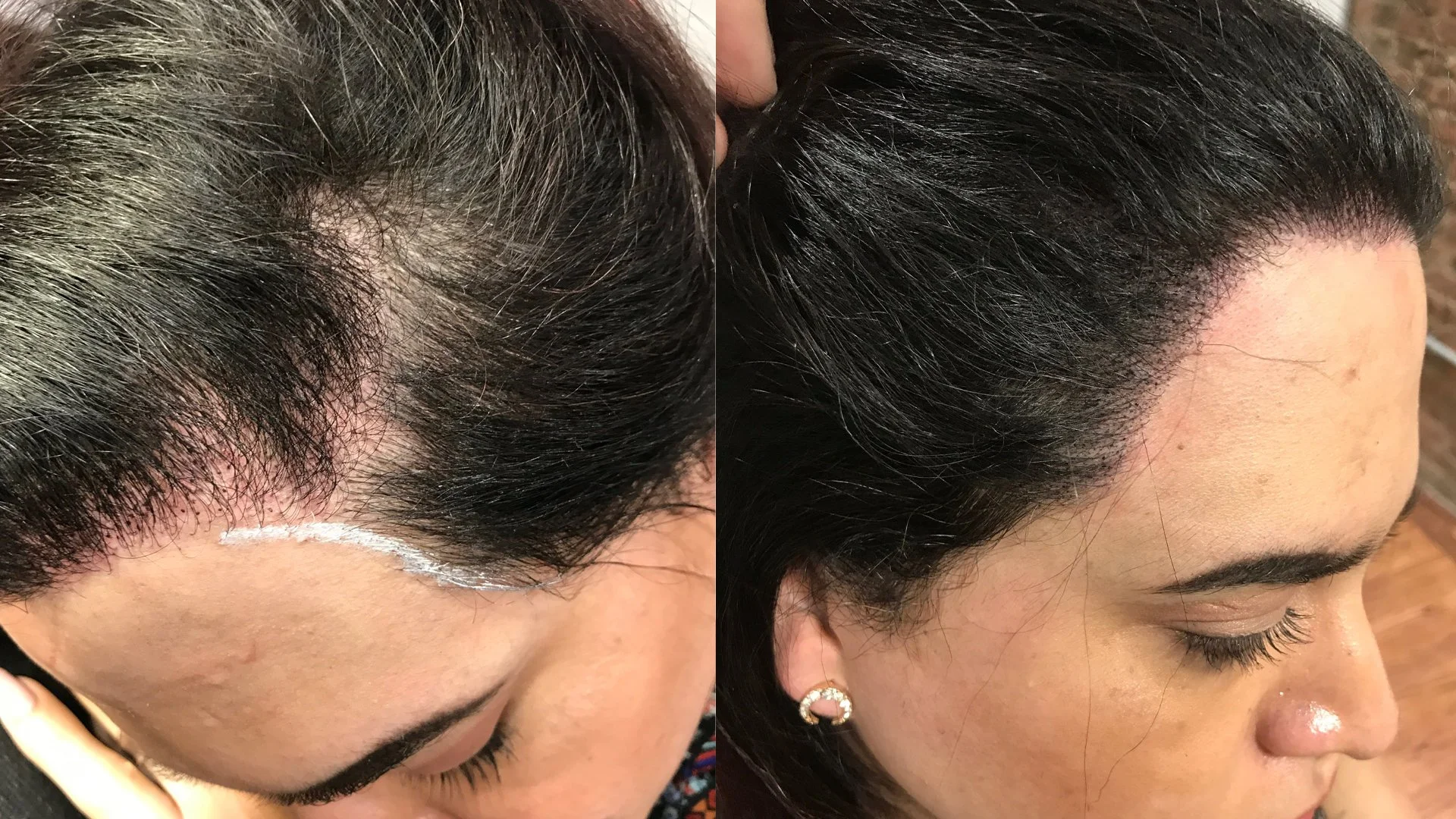 Scalp Micro USA - LA