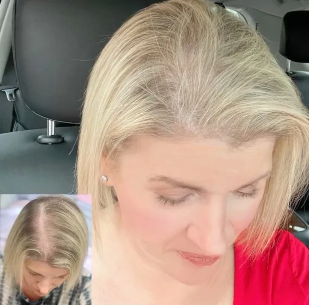 Precision Scalp Micropigmentation