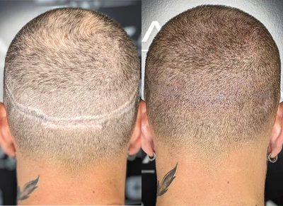 Precision Scalp Micropigmentation