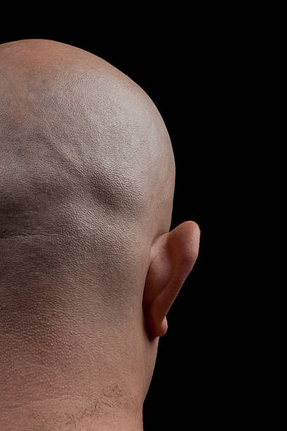 Precision Scalp Micropigmentation