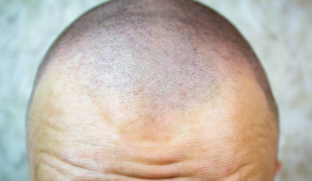 Precision Scalp Micropigmentation