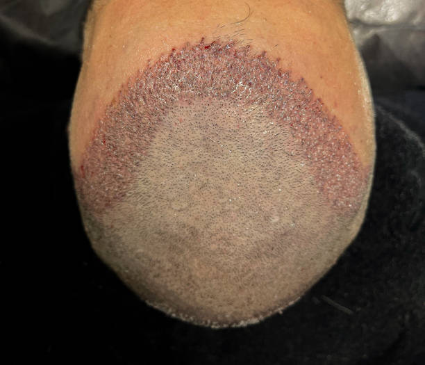 Alpha Micropigmentation